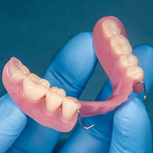 Removable Partial Dentures